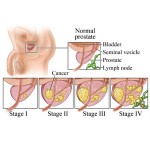 Testosterone injections versus prostate tumors