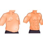 Testosterone teherapy for gynecomastia