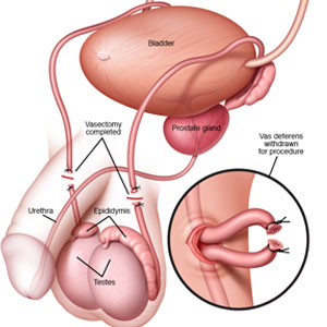 Vasectomy and testosterone levels